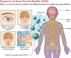 Image result for Myelitis