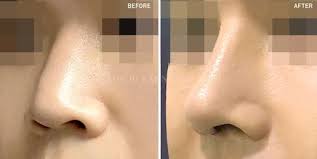Rhinoplasty in Los Angeles