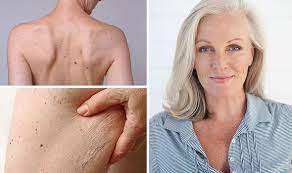 They appear as tan to dark brown spots or bumps on the skin, lips, and even eyes. Skin Cancer Symptoms The Difference Between Normal And Cancerous Moles On Your Body Express Co Uk