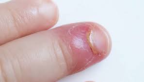 An ingrown nail on a cat can be clipped without anesthesia and followed by a course of antibiotics. Paronychia Causes And Treatment Of An Infected Nail