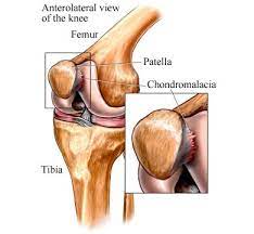 Chondromalacia Patella - Cancer Care Of Western New York