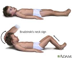 Initially, a breathing tube may be inserted for. Meningitis Information Mount Sinai New York