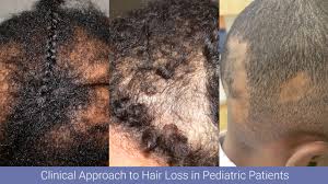 ● hair infections ● scalp conditions. Hair Apparent A Multi Part Series On Hair Disorders Part I A Clinical Approach To Hair Loss In Pediatric Patients Next Steps In Dermatology