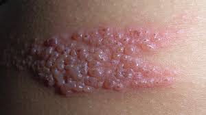 Rashes With Viruses Symptoms Causes Pictures And Treatment