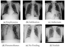 Check spelling or type a new query. Applied Sciences Free Full Text Classification And Predictions Of Lung Diseases From Chest X Rays Using Mobilenet V2