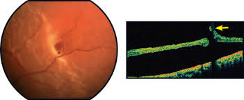 A retinal detachment occurs when the retina separates from its attachments to the tissues within the eye. Peripheral Retinal Degenerations And Rhegmatogenous Retinal Detachment Ento Key