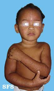 Image result for Papular Acrodermatitis