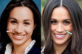 Weight Lose Best Product In 2020 Meghan Markle Plastic Surgery Plastic Surgery Photos Nose Job