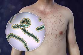 Etiopía confirma brote del virus de Marburgo