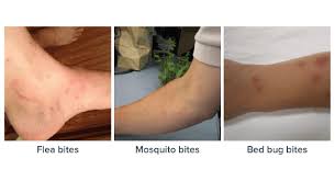 Image result for flea bites
