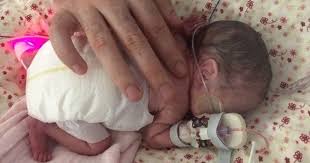 Find the perfect foetus at 23 weeks stock photo. Baby Born At 23 Weeks Was The Size Of Mum S Hand And Weighed Just Over 1lb Mirror Online