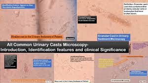 Image result for Urinary Cast