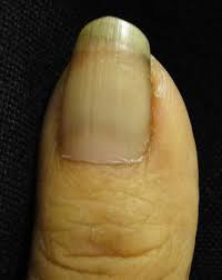 Image result for Muehrcke Line