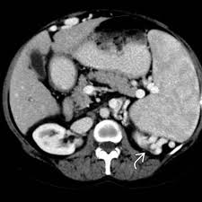 Image result for Splenomegaly
