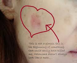 Bernice kwong, a clinical associate professor of dermatology at stanford university shares skincare advice for. Melanoma Doesn T Always Look Like A Mole I Learned The Hard Way Imgur