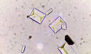 Types Of Crystals Found In Human Urine And Their Clinical