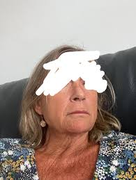I have contacted several surgeons in Turkey for alarplasty only as I hate  my nostrils. Each have come back to suggest full rhinoplasty or tip plasty.  In the uk a consultant has