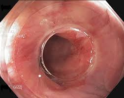 فتحة الشرج تشريح جسم الإنسان الصورة التعريف الشروط والمزيد اضطرابات هضمية 2021