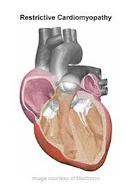 Image result for Cardiomyopathy