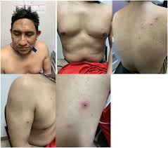 Image result for Rickettsialpox