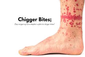 Chiggers belong to the trombiculidae family. How To Treat Chigger Bites 10 Proven Natural Remedies How To Cure