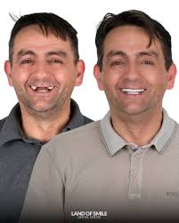 Dental Implant Treatment in Turkey with Lando's Smile