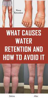 Artery Defence - Water Retention Sometimes Seems Impossible To Get Rid Of.  Often Times Water Retention Is Easier To Prevent Than Getting Rid Of It.  So, Here Are The Causes Of Water