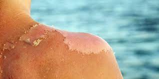 Depending on its severity, your skin could shed for up to two weeks. Sunburn Peeling Why Sunburned Skin Peels How To Stop It