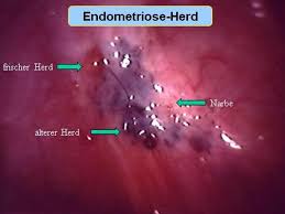 Endometriose wird häufig sehr spät diagnostiziert. Ivf Saar Endometriose Infoabend