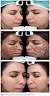 Chemical Peel Burn Scars