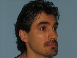 Rhinoplasty Before and After Photos by Paul Vanek, MD, FACS; Concord, OH