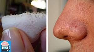 Einfacher Trick Gegen Pickel Und Mitesser Kostenlos Hausmittel Youtube