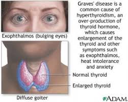 Women are three times more likely to develop thyroid cancer than men. Hyperthyroidism Physiopedia