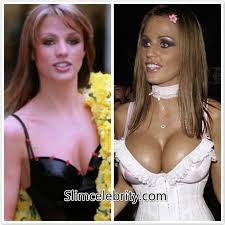 Résultat de recherche d'images pour "breast implant before and after"