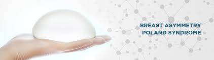 Poland syndrome is a rare disorder of multifactorial origin. Breast Asymmetry Poland Syndrome Advanced Laser And Plastic Surgery