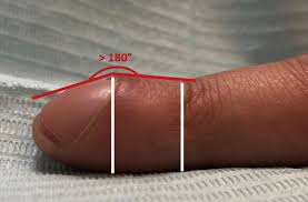 Image result for Digital Clubbing