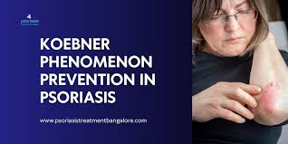 Image result for koebner phenomenon psoriasis
