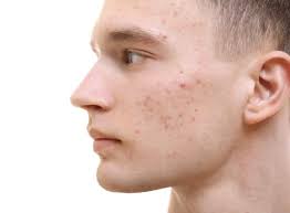 Use os dedos para aplicar uma fina camada do produto caseiro no nariz e deixe no rosto por 15 minutos, até secar. Homens Que Se Cuidam Cravo No Rosto Como Prevenir E Tratar