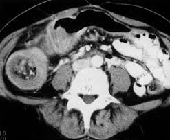 Unfortunately, ct scans are not very good at finding small polyps like a colonoscopy does. Spiral Ct Of Colon Cancer Imaging Features And Role In Management Radiographics