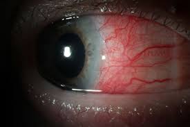 This comprises the iris, ciliary body, and choroid. Uveitis And Scleritis 2020 The Year Of Excellent Vision