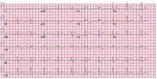 ***correction #39 heart rate is 60. Ecg Ekg Examples And Quiz Oxford Medical Education