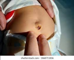 Image result for Umbilicus