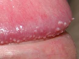 Tyson Glands - Tyson Glands Remove In 3 Days - Remove At Home In Quarantine Tyson  Glands - Youtube