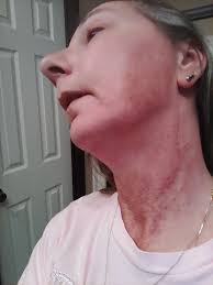 Can some please treat Tanner Lee Richard for sun stroke.