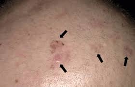 This is common among people who dye their hair. 10 Reasons Your Scalp Itches And How To Get Relief