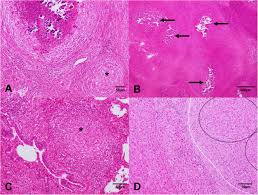 They form as a reaction to, for example, infections or foreign objects. Histopathological And Microbiological Study Of Porcine Lymphadenitis Contributions To Diagnosis And Control Of The Disease Porcine Health Management Full Text