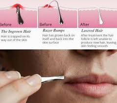 You may see excess hair on the face, shoulders, lower abdomen, back, and on the back of the neck. Pin On Waxing