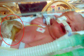 We no longer rely on these organs or structures for any serious function, or they have atrophied or degenerated to the point that they don't serve the. Baby Has Three Organs Outside Body And Piper Smith S Bladder Is Wrapped In Cling Film Mirror Online