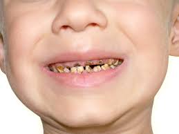 Learn more about it, here. à¤¦ à¤¦ à¤® à¤• à¤¨ à¤¸ à¤– à¤¸ 2 à¤¦ à¤¨ à¤® à¤¦ à¤° à¤•à¤° à¤¦ à¤¤ à¤• à¤• à¤¡ à¤• Home Remedies To Remove Tooth Worm Hindi Boldsky