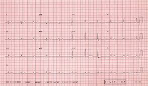 Image result for Q Wave